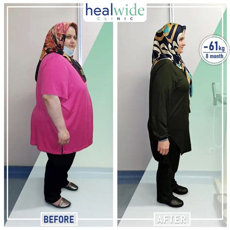 hermes clinic turkey gastric sleeve reviews|gastric sleeve turkey cost.